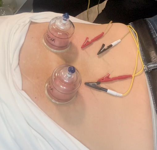 Close-up of a person's back undergoing cupping therapy with electrodes and clips attached.