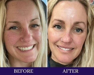 Side-by-side comparison showing a woman's face before and after a skincare treatment, highlighting noticeable improvements.