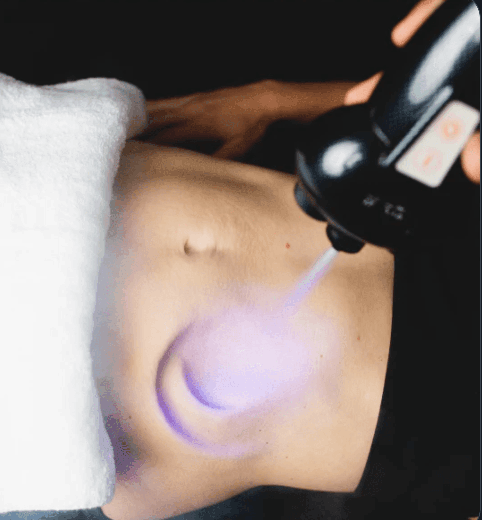 CryoSlimming | CryoSculpting