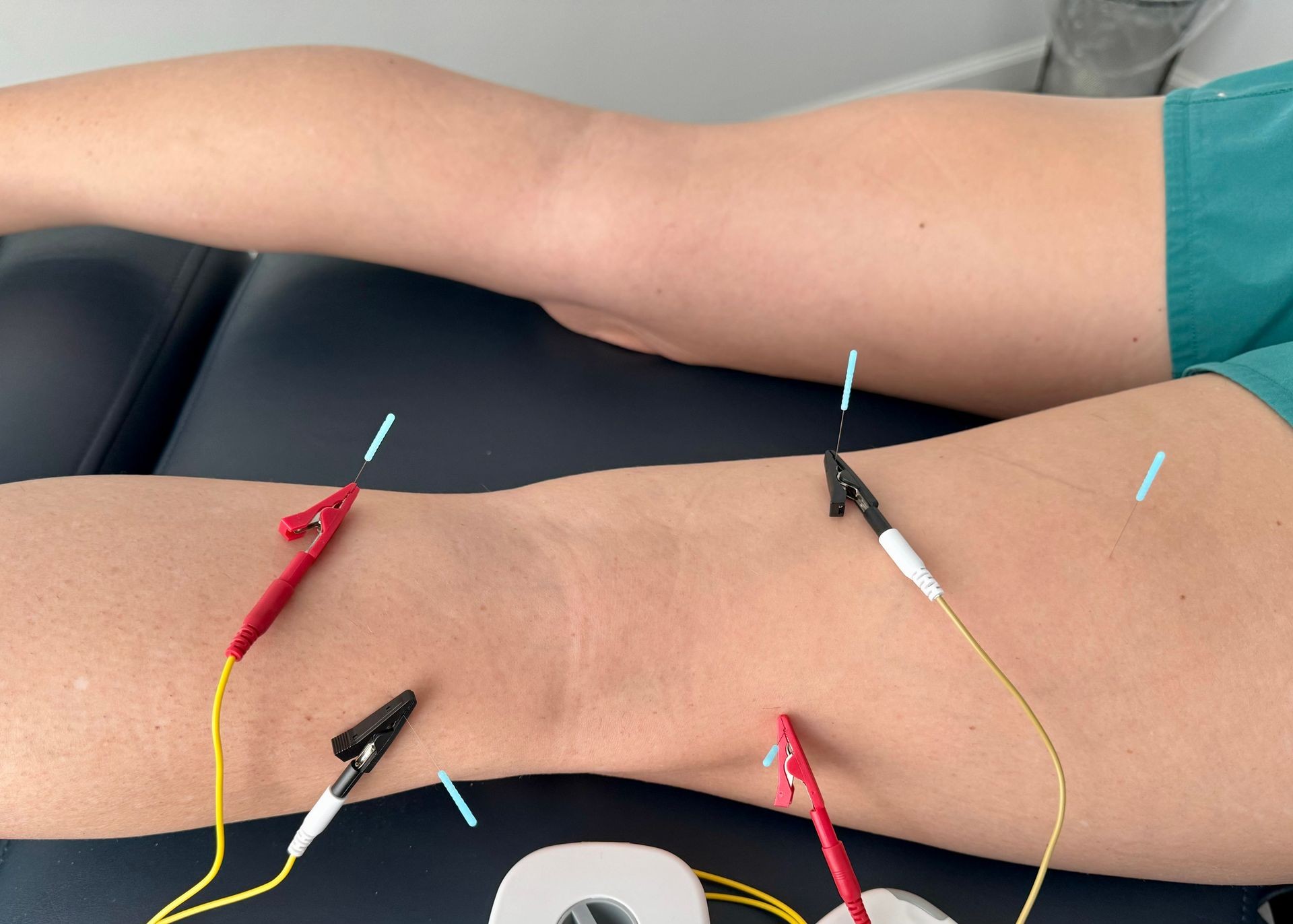 What Conditions Can Dry Needling Help Treat?