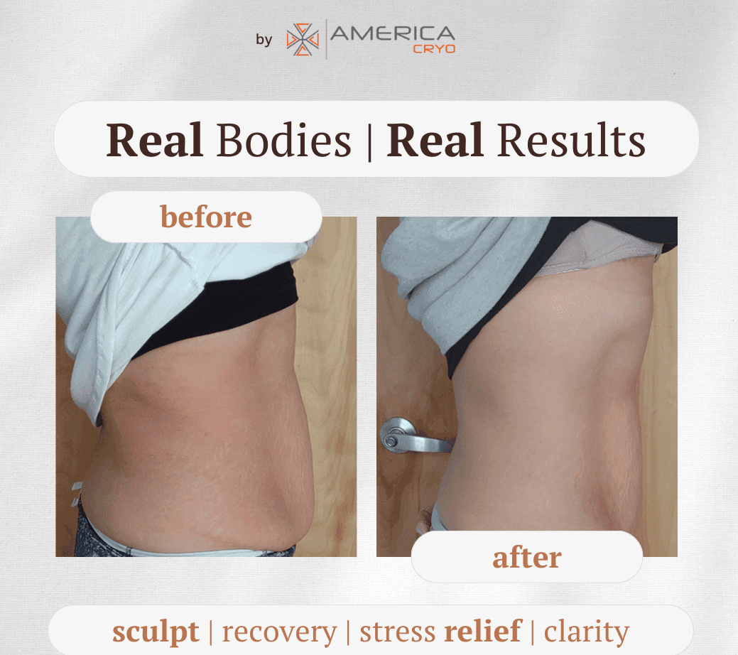 Before and after images of a person's midsection showing body transformation with America Cryo services.