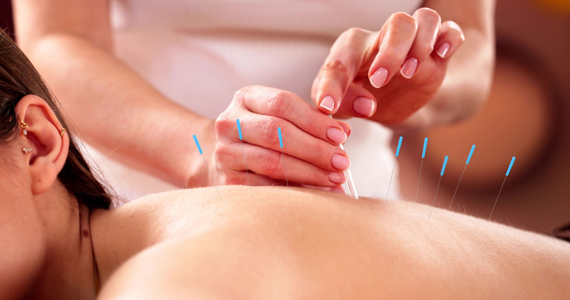 The woman is receiving acupuncture dry needle treatment by a therapist