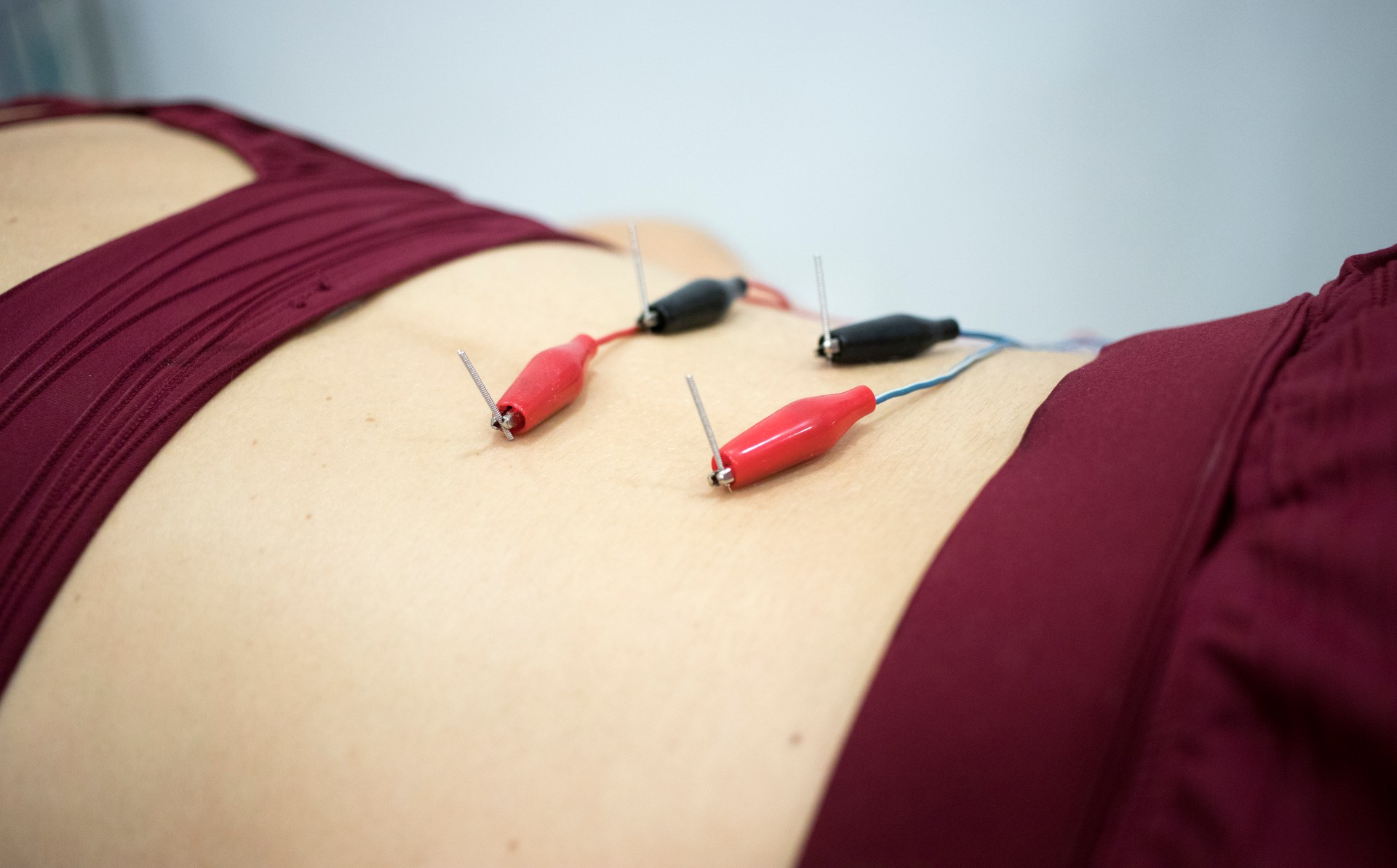 Dry Needling