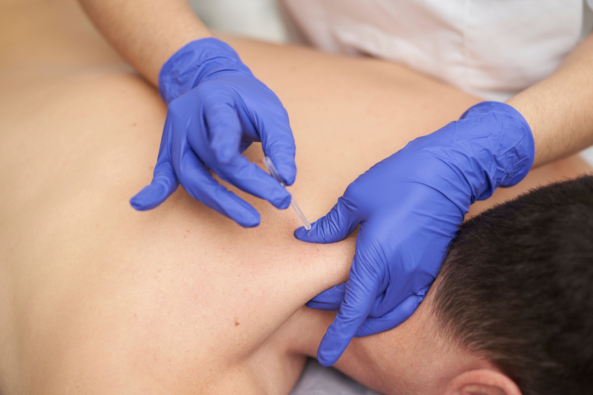 dry needling chiropractic