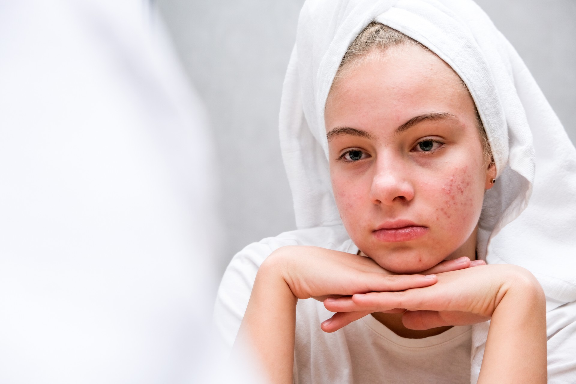 Acne. A sad teenage girl. Problematic skin in adolescents.