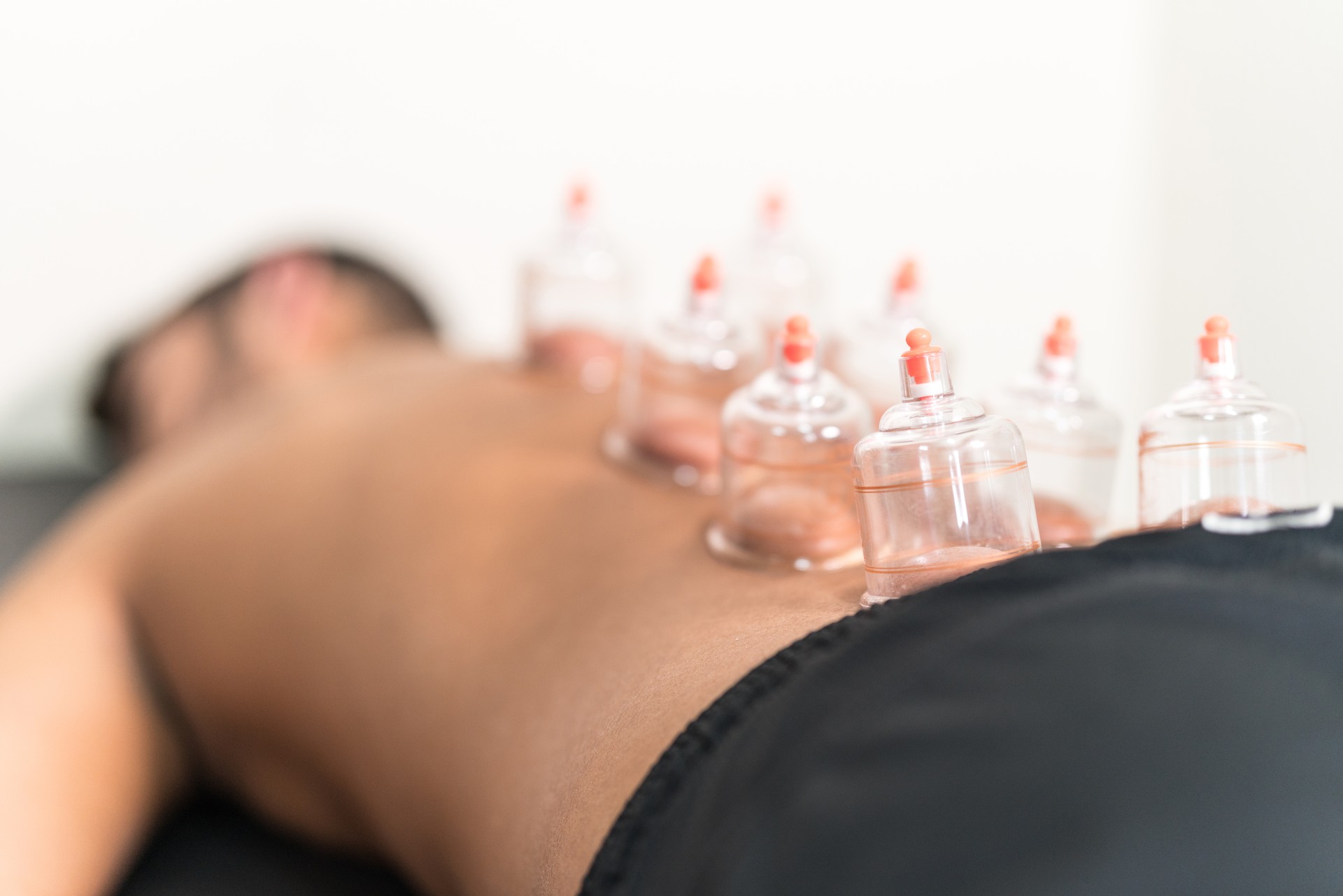 Applying cupping therapy in traditional chinese medicine on man back